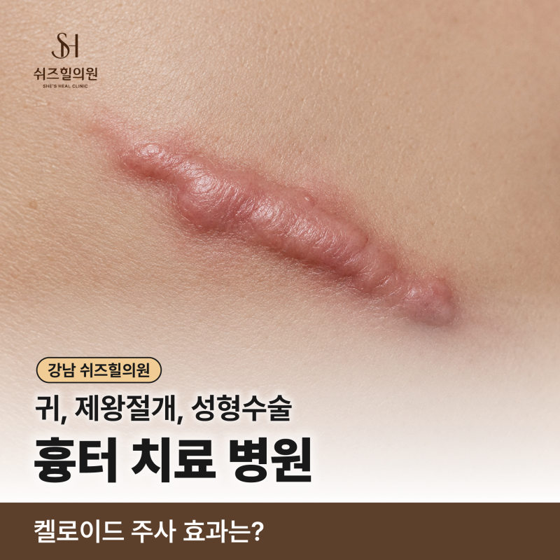 강남 귀, 제왕절개, 성형수술 흉터 치료 병원, 켈로이드 주사 효과는?