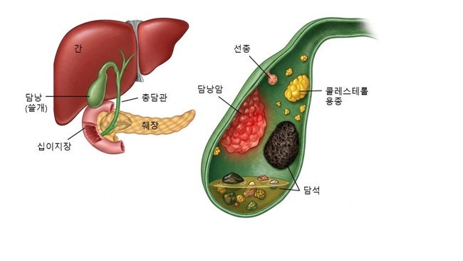 건강검진에서 발견된 담낭용종, 담낭암이 될 수 있을까요? -담낭질환 이야기 1 담낭용종