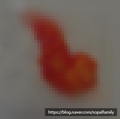 내 몸에서 낯선 덩어리를 꺼냈다 : 지방종 제거 후기