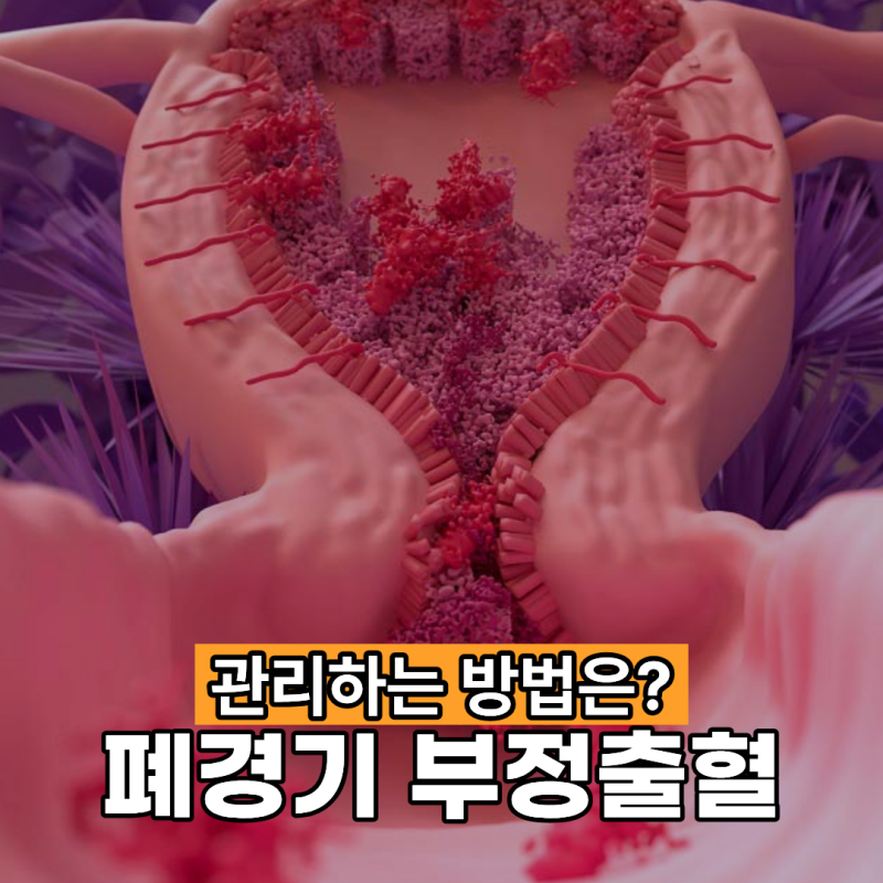 폐경기 부정출혈 관리하는 방법