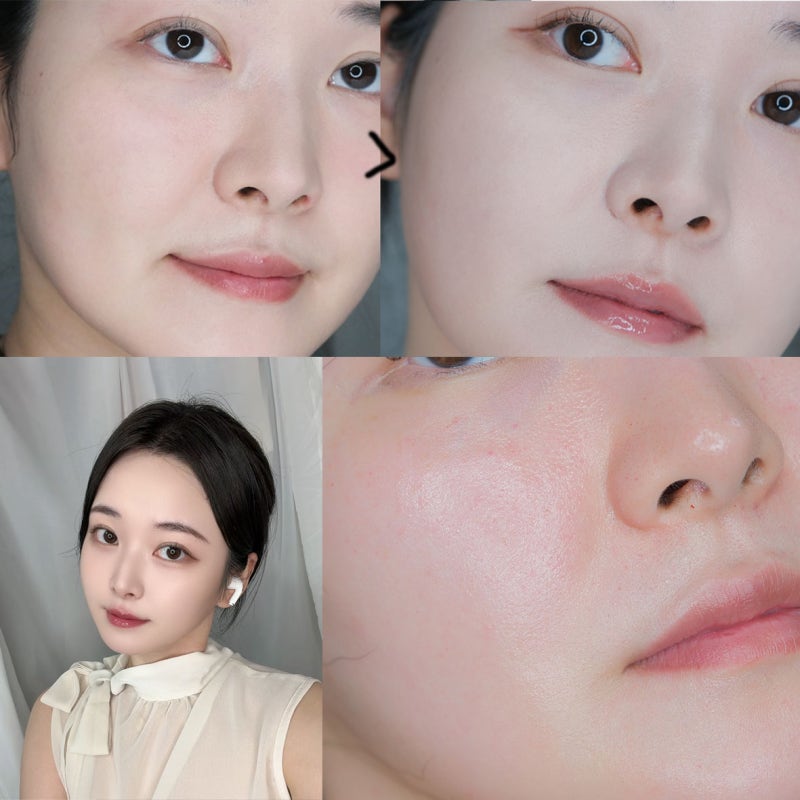 고우리 스킨부스터 압구정피부과 후기, 땅콩형얼굴 탈출