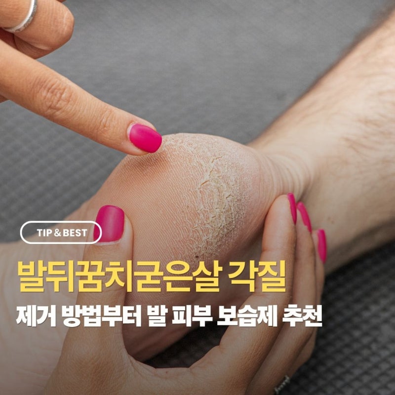 발뒤꿈치굳은살 각질제거방법부터 피부 보습제 추천까지