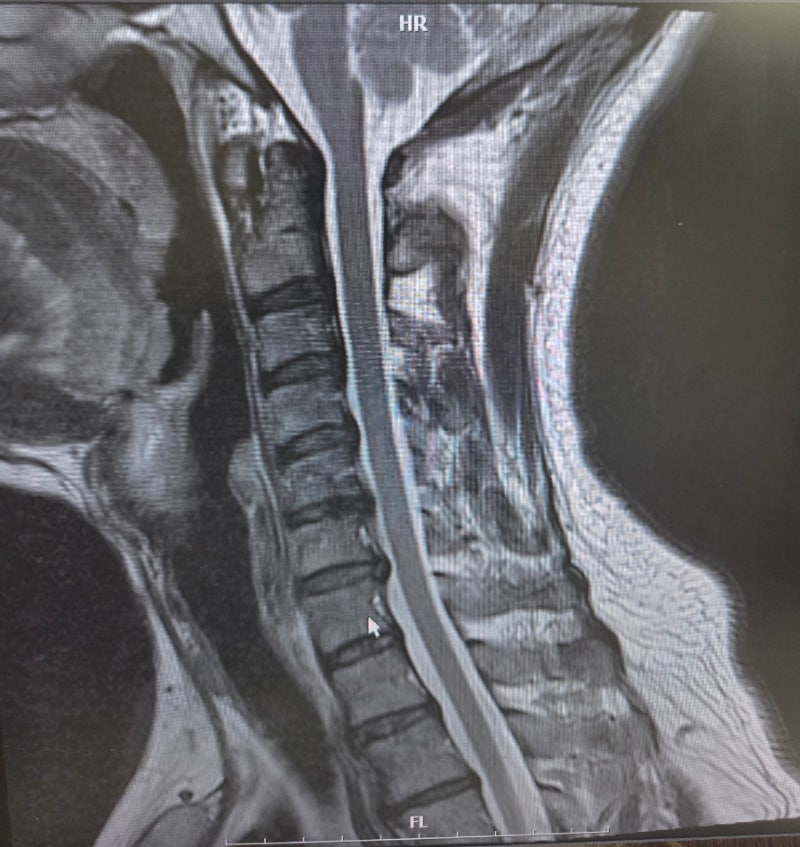 목디스크가 혈압까지 올려요? 실제 MRI 사례로 보는 등·견갑골 방사통과 비수술 치료