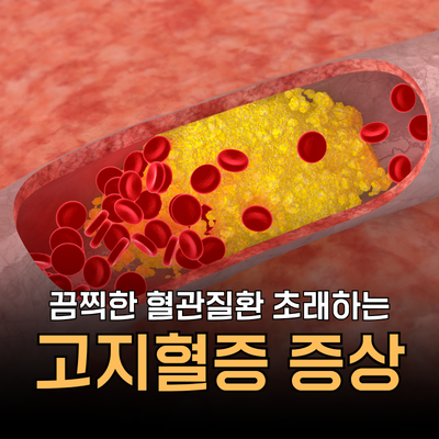 겉으론 모릅니다! 고지혈증 증상 원인 대처법 및 주의사항, 예방법