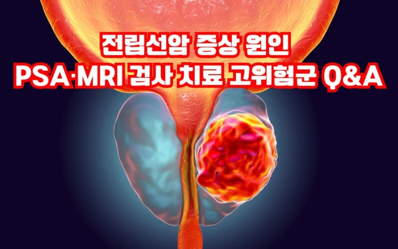 전립선암 배뇨 혈뇨 골반통 증상 원인 PSA·MRI 검사와 치료 고위험군 Q&A