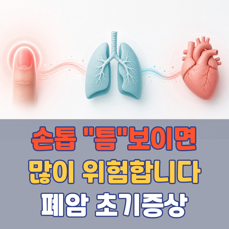 "손톱 봤는데 '이 틈' 보이면 위험합니다" 놓치기 쉬운 곤봉지증상 | 폐암초기증상 자가진단