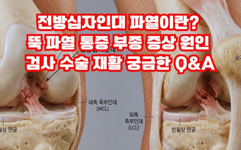 전방십자인대 파열 뚝 파열 통증 부종 증상 원인 검사 수술 치료 재활 회복 장애등급 Q&A