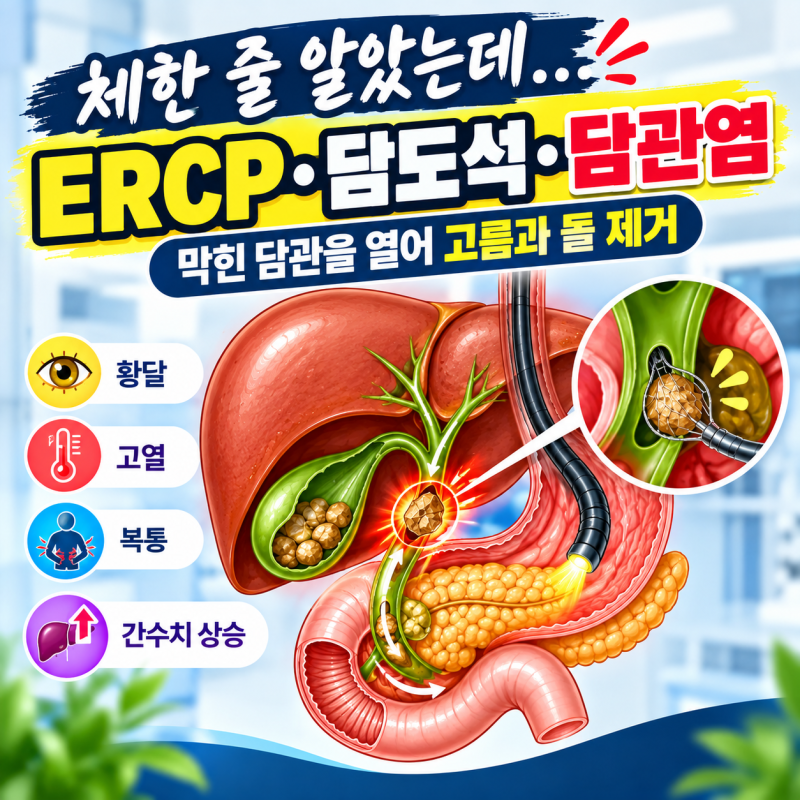 간수치 급상승과 황달! 급성 담관염 원인과 ERCP 담도 고름 제거 후기