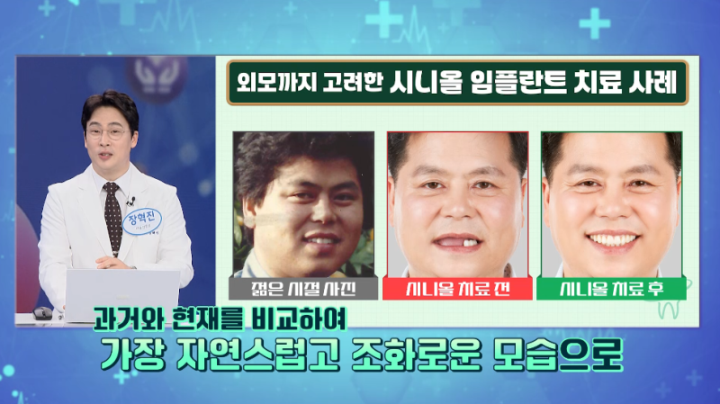 앞니 임플란트, 임시치아 당일에 가능한 치료 방법과 조건