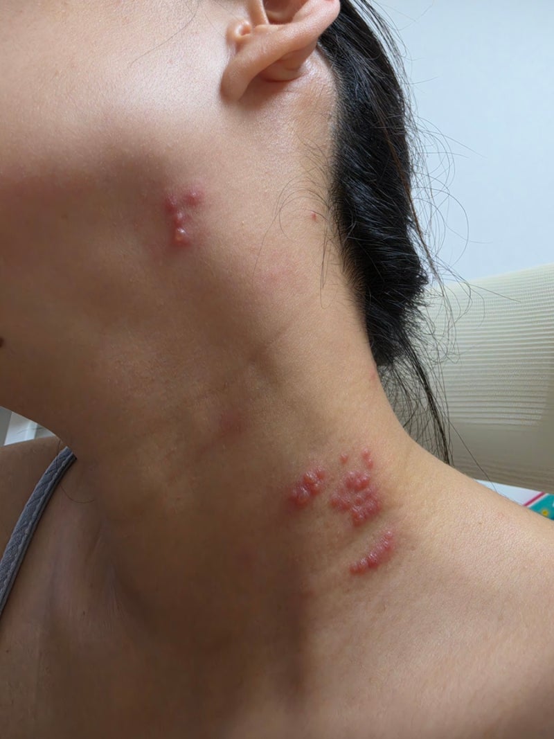 임신 초기 대상포진 2 임산부 대상포진약 복용 후기, 5일간 병가