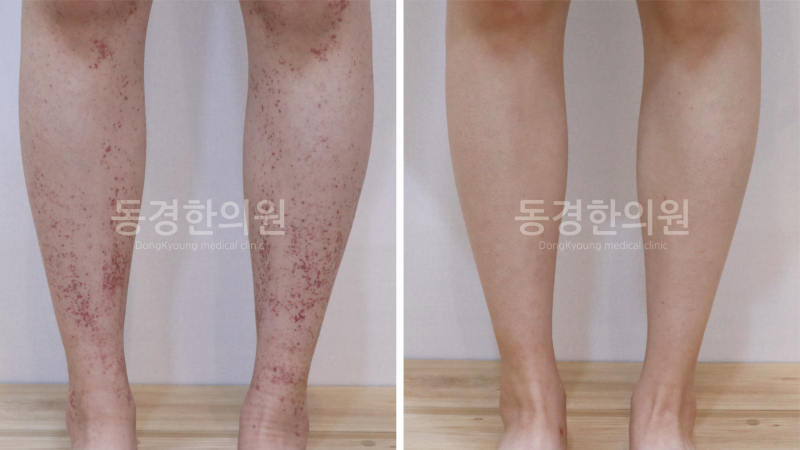 몸 붉은 반점, 알레르기 자반증 대표 증상과 치료 방법