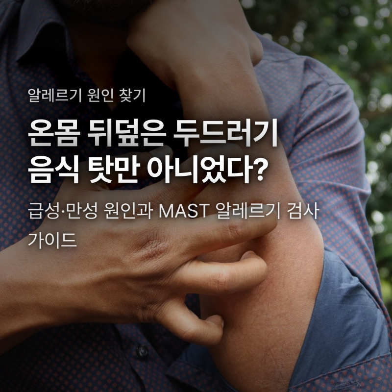 두드러기 원인 음식 때문일까? MAST 알레르기 검사 비용과 반전 결과