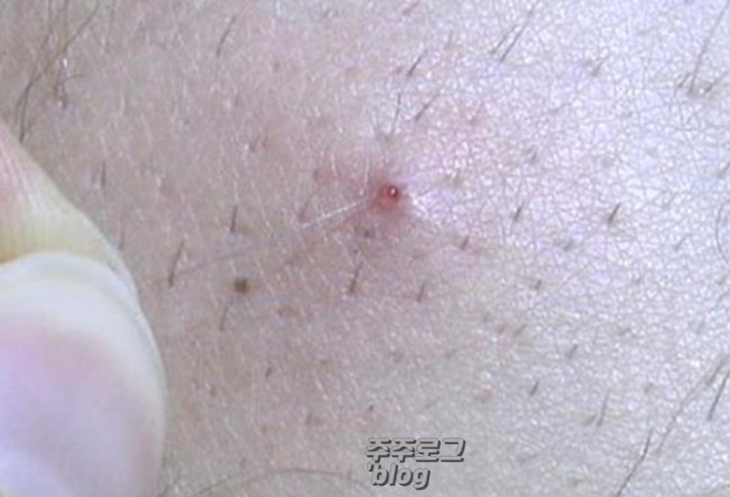 다리 인그로운헤어 제거 방법 핀셋? 바디스크럽? 모낭염만 생길 수 있으니 이방법으로!