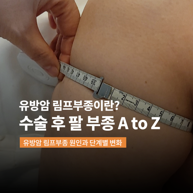 유방암 림프부종이란? 수술 후 팔 부종 A to Z