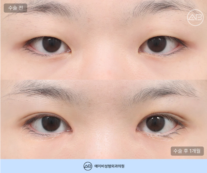 에이비성형외과 무쌍 여자 눈매교정 쌍꺼풀 수술 체크포인트