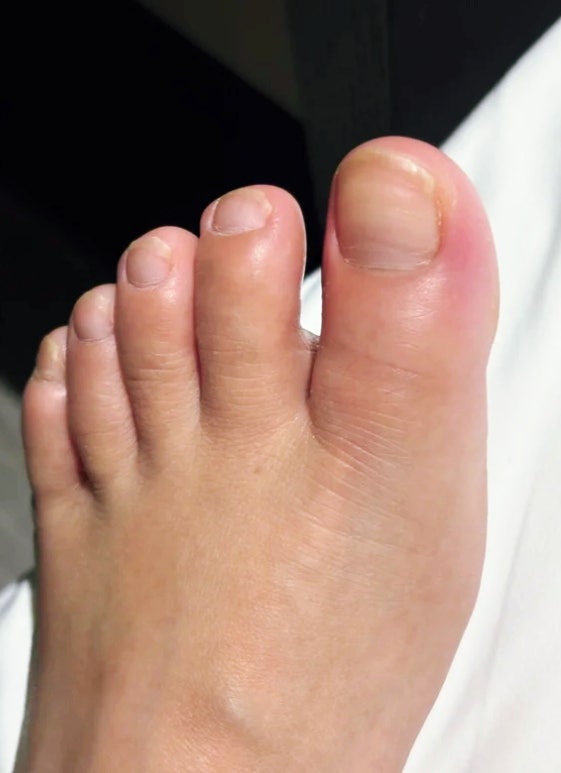 통풍에 좋은 영양제 통풍 재발 겪고 요산관리까지 해 본 진짜 후기