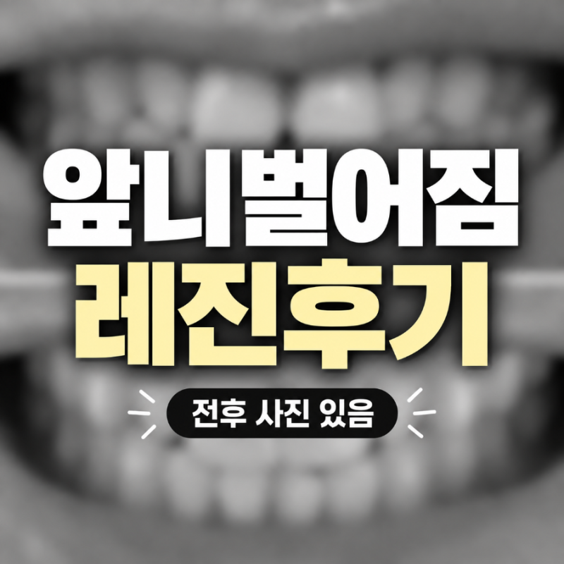 [찐내돈내산]앞니 벌어짐 레진 후기｜진작 할껄...치아 사이 메우기 전후 + 가격