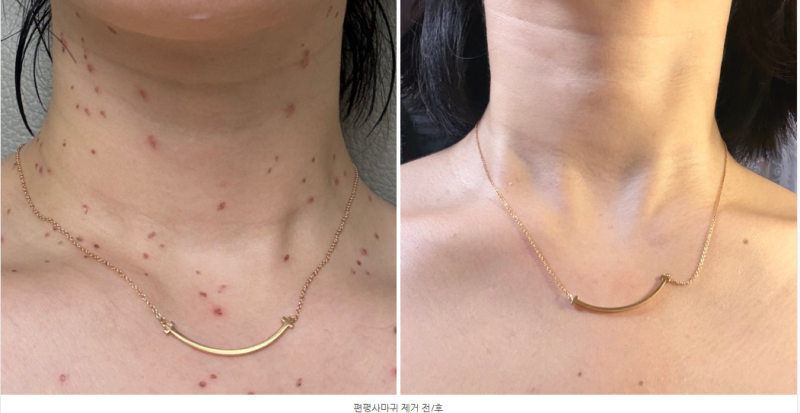 대구 편평사마귀 제거 한의원 목전체 편평사마귀 제거 거우침 후기