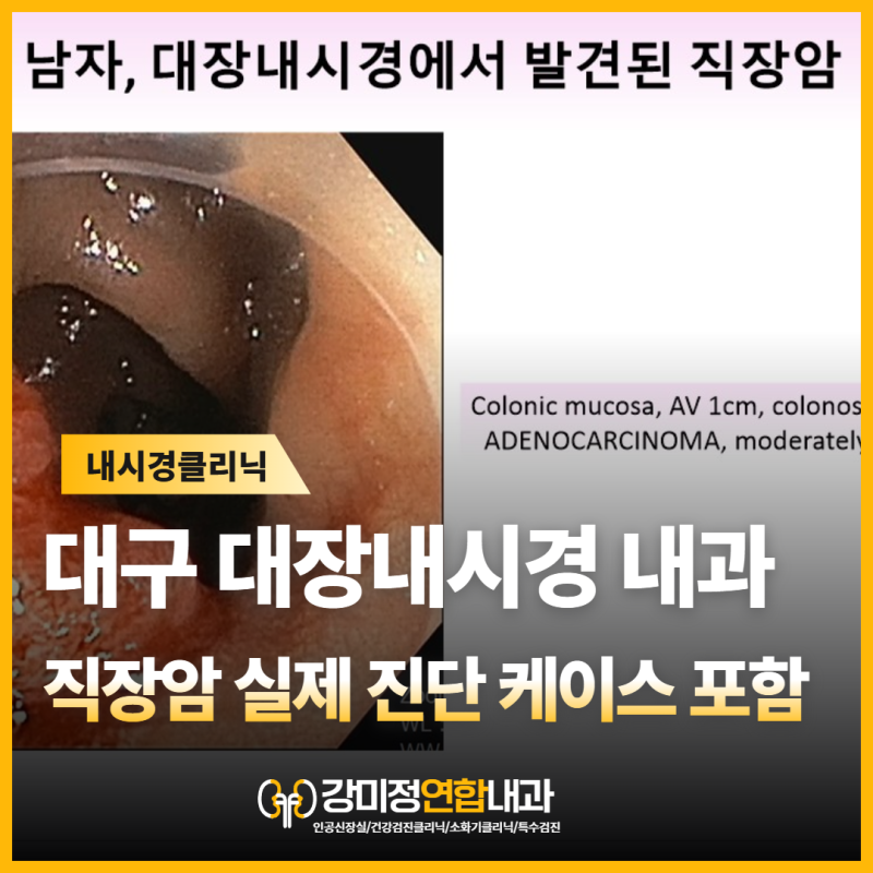수성구 대장내시경, 70대 남성에게서 발견된 직장암…제가 검사 중 먼저 본 것은