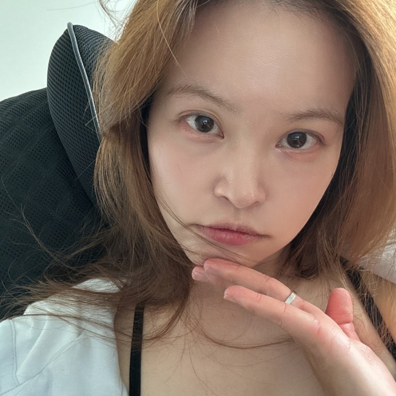 강남역 피부과에서 고우리 + 티타늄리프팅 20kj 로 볼륨채우고 턱선 만든 후기