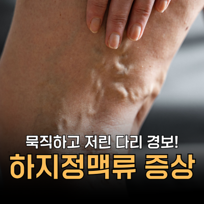 병원 가야 할 하지정맥류 증상 4가지 원인과 예방법은?