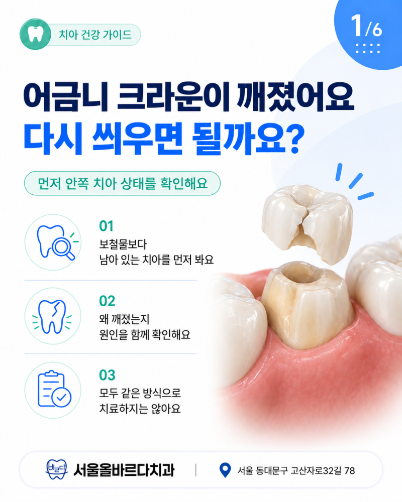 안암동치과 어금니 크라운 보철이 깨졌는데 다시 씌우면 될까요