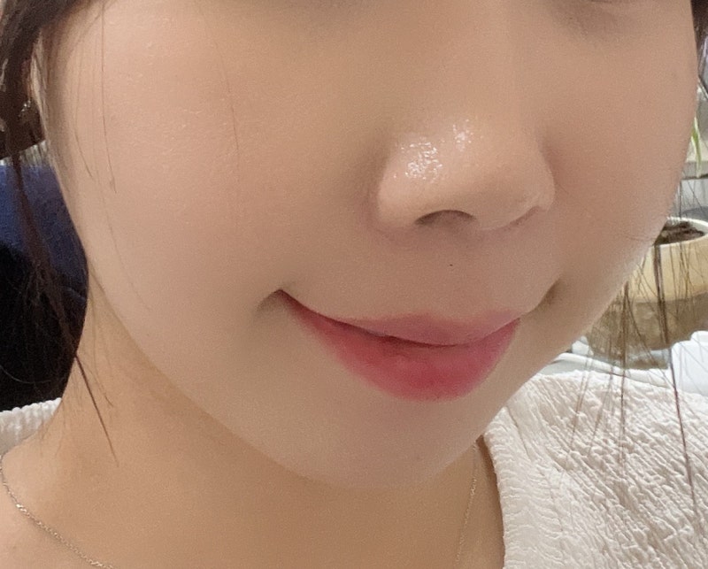 논현역피부과 올리디아120 콜라겐스킨부스터주사 후기 속건조 고민 개선 효과