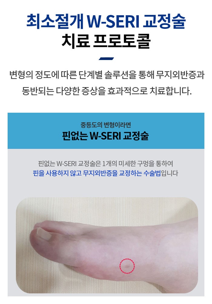 무지외반증병원추천, 수술을 고민한다면 꼭 확인해야 할 3가지