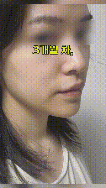 주걱턱 교정 부작용, 이렇게하다 비용만 낭비했어요ㅠ