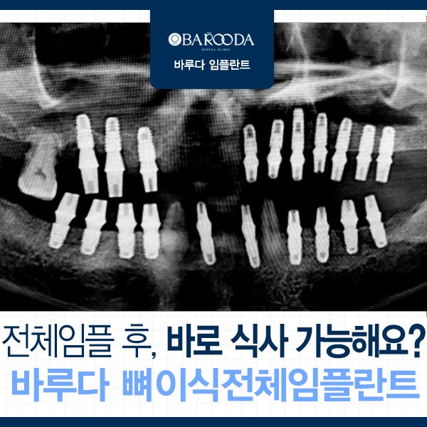 해남에서 오신 어머니,"전체임플란트해도 바로 식사할수 있어요?" 바루다치과라면 가능합니....