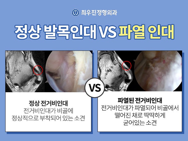 발목인대 MRI 인대 파열 여부에 따른 맞춤 케어가 중요