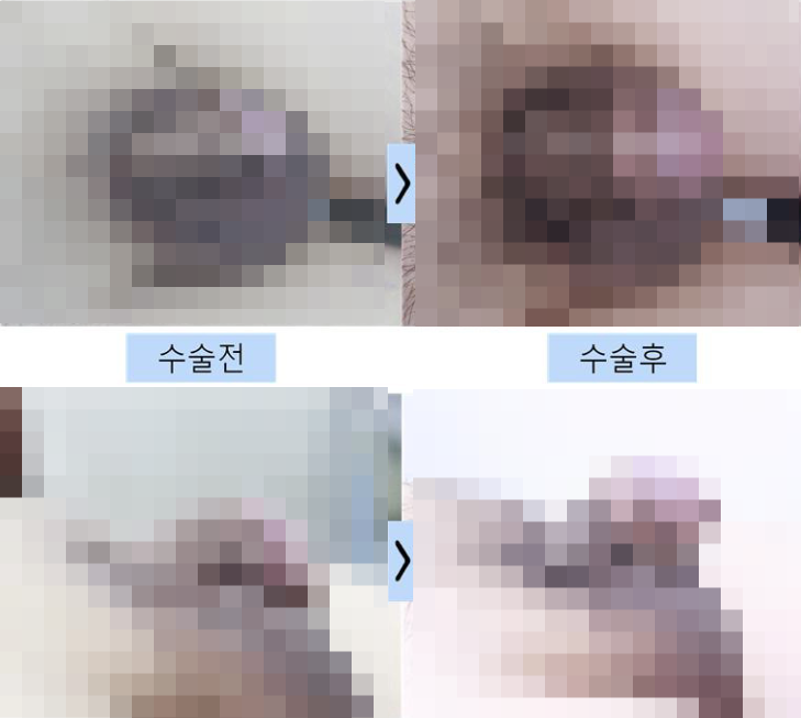 남성조루증치료, 원인 확인 없이 수술부터 하면 안 되는 이유