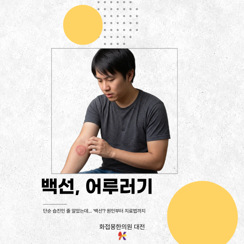 대전 백선(사타구니 습진, 체부백선 등), 단순 습진인 줄 알고 연고 발랐다가 더 번질 수 있다....