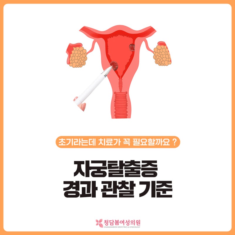 자궁탈출증 초기라고 들었는데 치료가 꼭 필요할까요 | 경과관찰과 상담 기준 정리