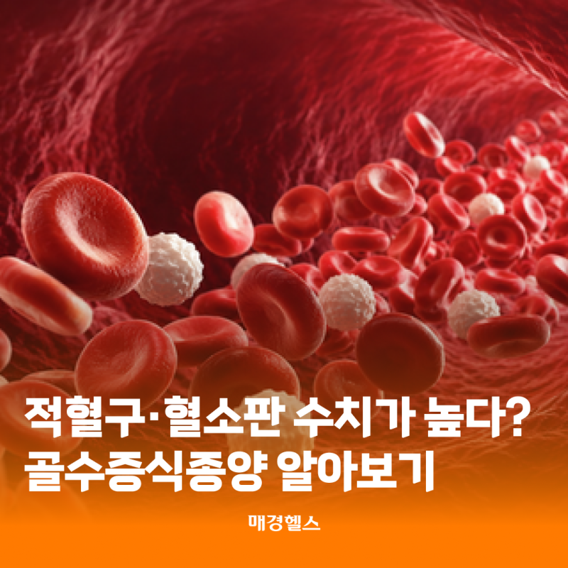적혈구·혈소판 수치가 높다?골수증식종양 알아보기