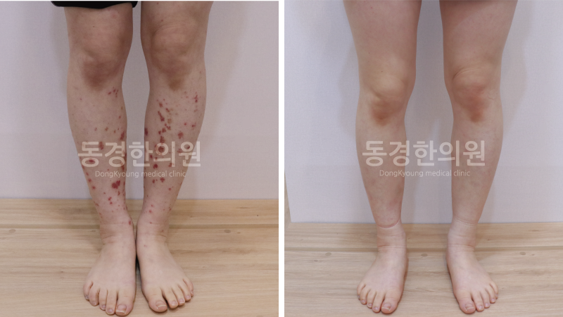피부 붉은 반점 자반증일까? 원인부터 치료 방법까지