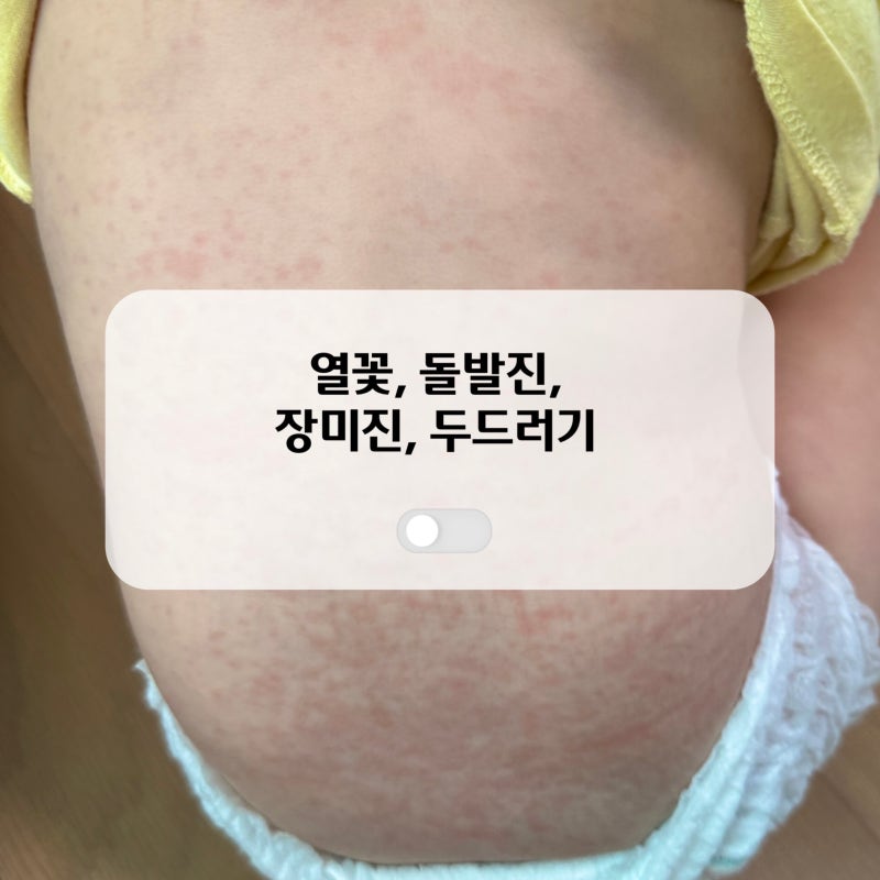 아기 열꽃 장미진 돌발진 두드러기 차이 총정리(feat.대처법)