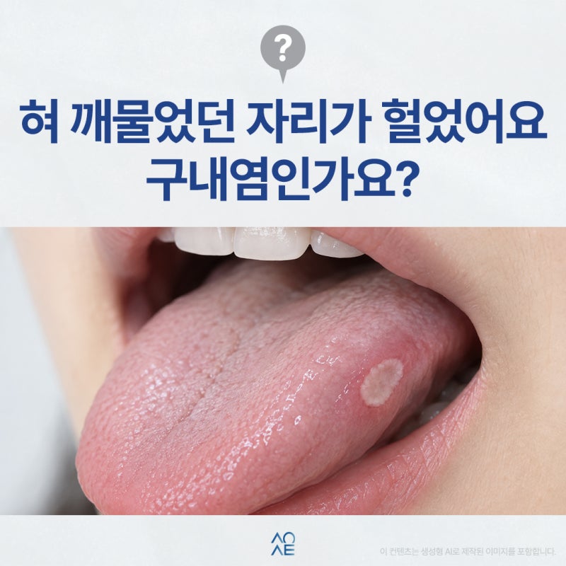 혓바닥 구내염 혀 세게 깨물었다가 생길 수 있는 건가요?