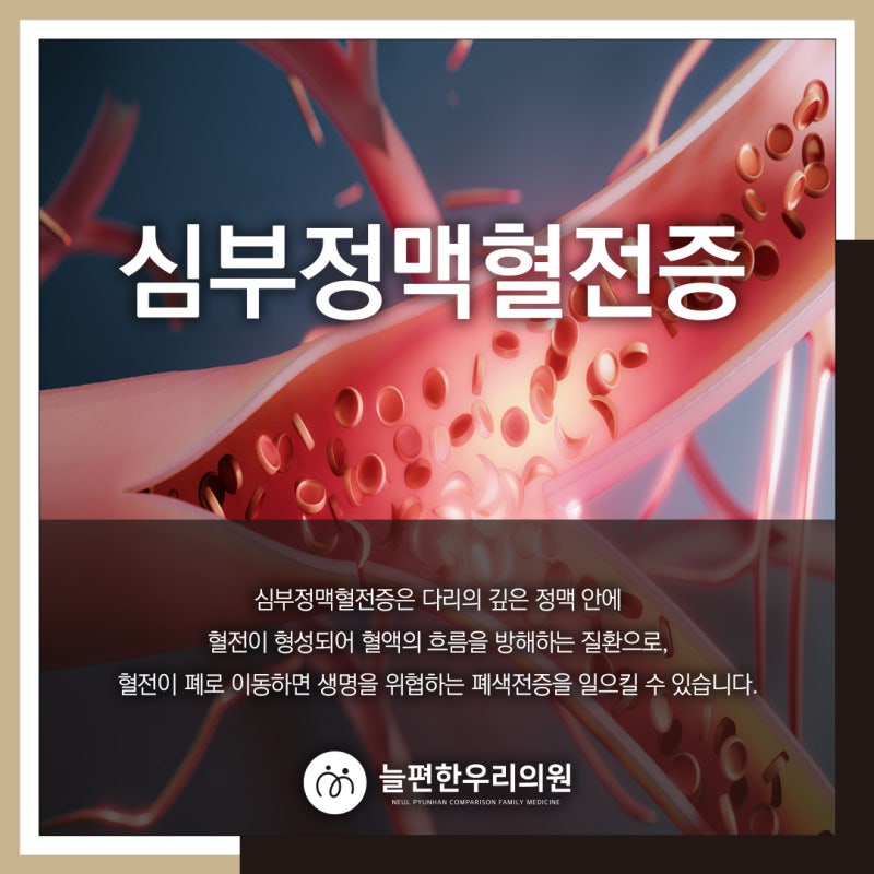 깊은 정맥 안에 혈전이 형성되어 혈액의 흐름을 방해하는 질환인 심부정맥혈전증