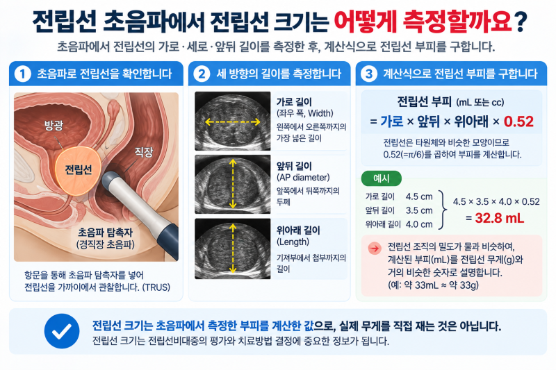 전립선 초음파에서 전립선 크기는 어떻게 측정할까요?