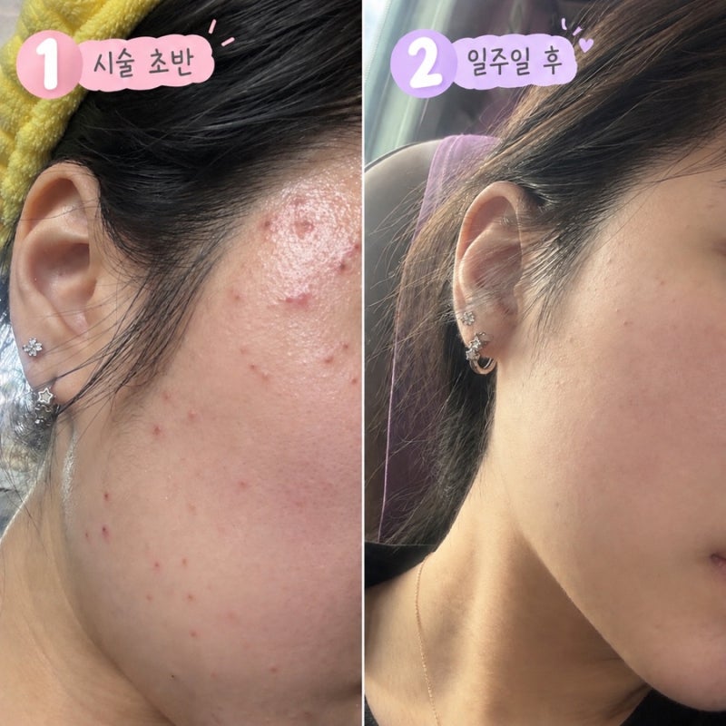 [내돈내산] 편평사마귀 10만원대 무제한 레이저 제거 후기ㅣ듀오덤❌, 변화, 비용, 통증, 흉터....