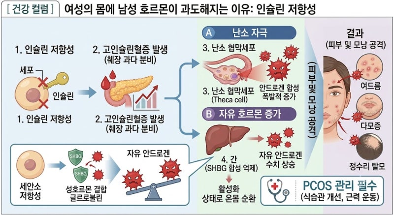 "여드름·탈모·털 고민의 범인은 남성호르몬?" — 다낭성 난소 증후군과 고안드로겐혈증 다....