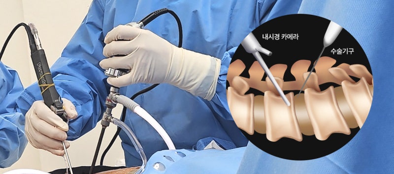 허리디스크 시술 비용 신경성형술 가격까지 정리