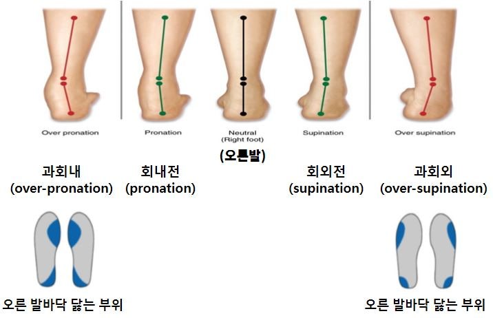 걸을 때 발이 안쪽으로 많이 움직이면? - 과회내(Overpronation)란? (신발과 보행 이야기 #081)