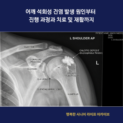 어깨 석회성 건염 발생 원인부터 진행 과정과 치료 및 재활까지