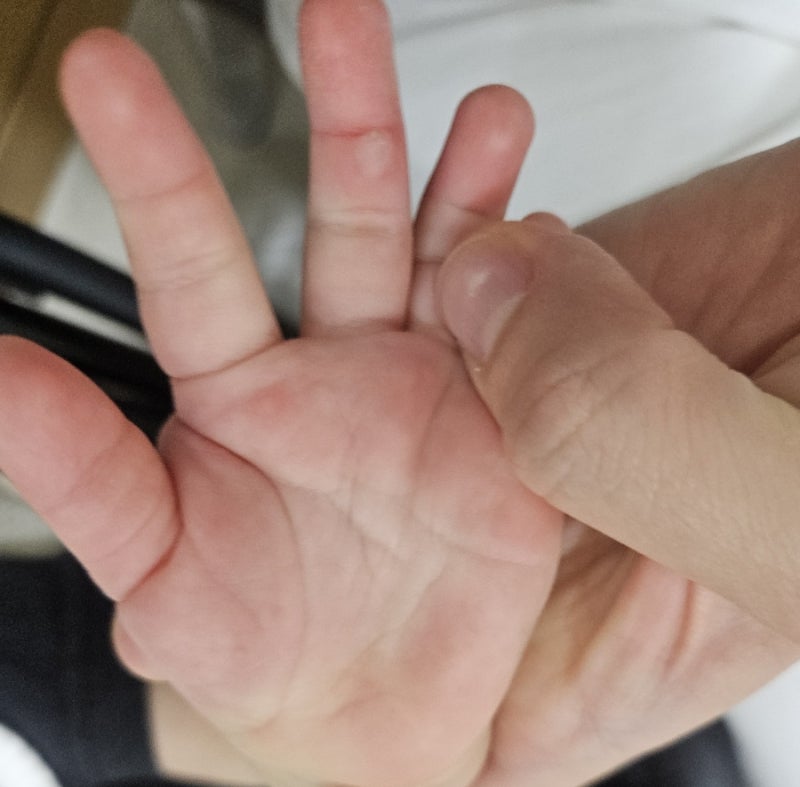 아기손 화상 대처법(아기화상, 아기 손물집 대처, 아기 진주화상병원)