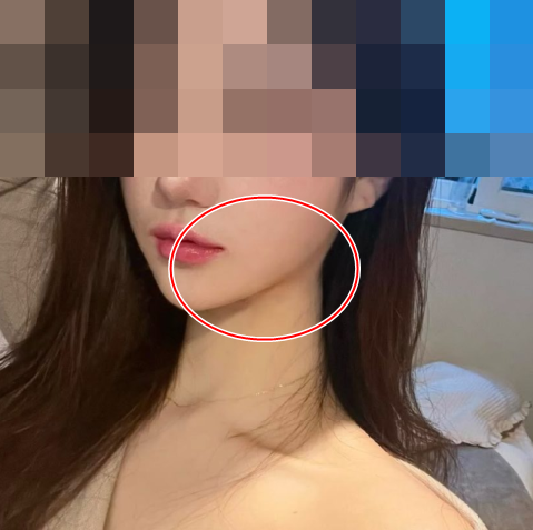 마르지 않는 샘, 강남 침샘보톡스를 통한 V라인 효과 후기를 보면?