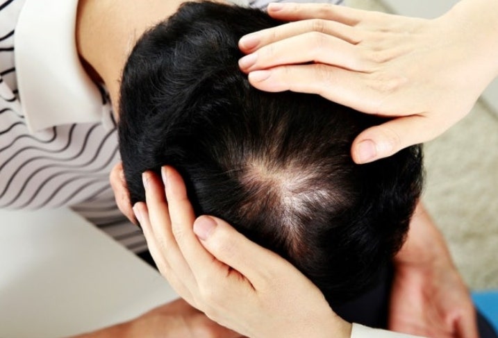 남자 먹는 탈모약 피나스테리드정 두타스테리드정 효과 부작용