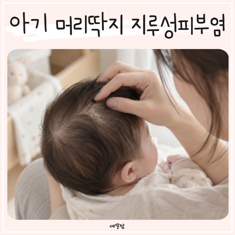 아기 머리딱지 왜 생길까? 신생아 두피각질 지루성피부염 증상