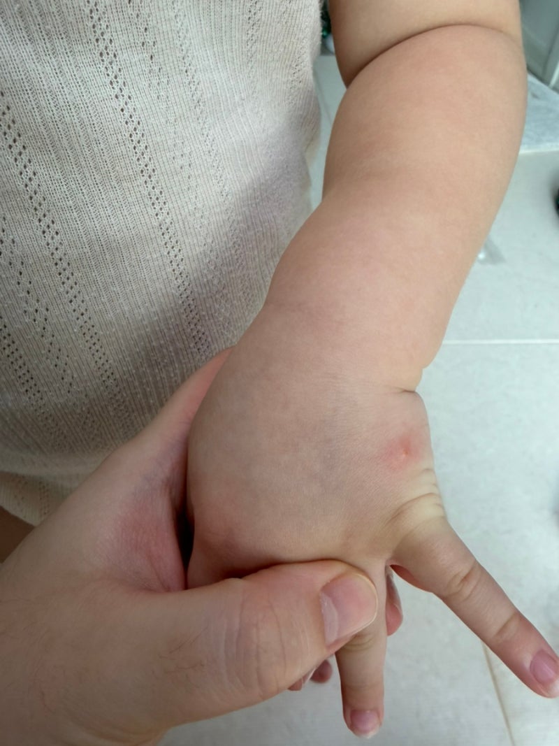 가을모기 극성! 아기 모기에 물렸을 때 어떤 약을 바를까? (개월수 별 정리)